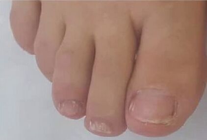 Brand FULYGENT sand Szybko pozbył się mykozy